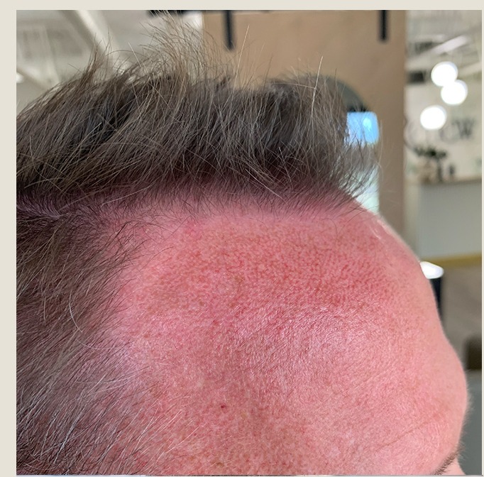 James after 15 months of treatment