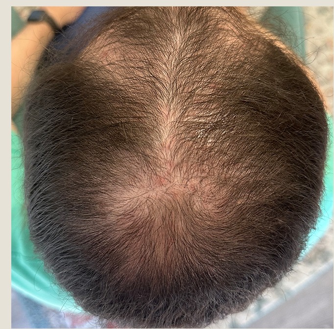 Jon after 6 months of treatment