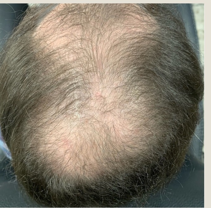 Jon before treatment