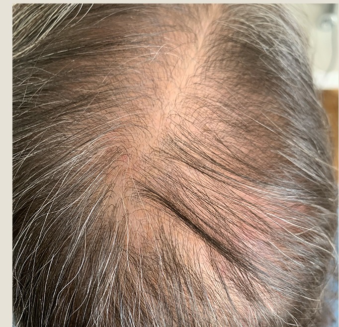 Susie after 9 months of treatment