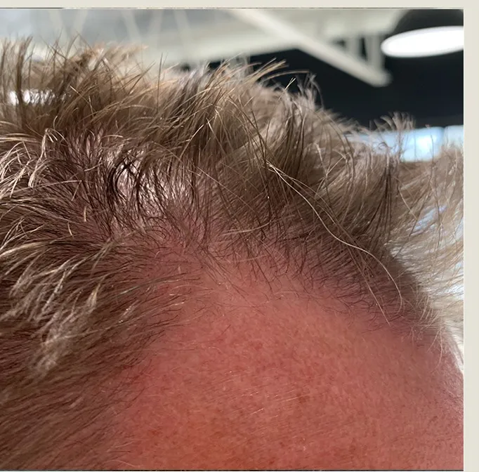 James before treatment