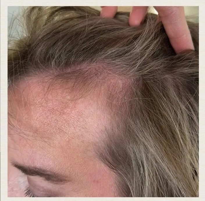 After 4 Months of treatment