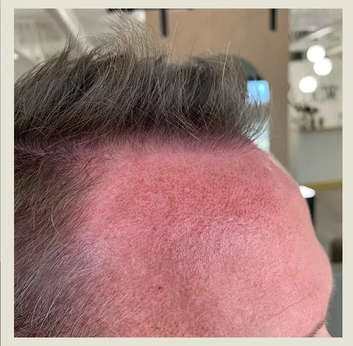 After 15 Months of treatment