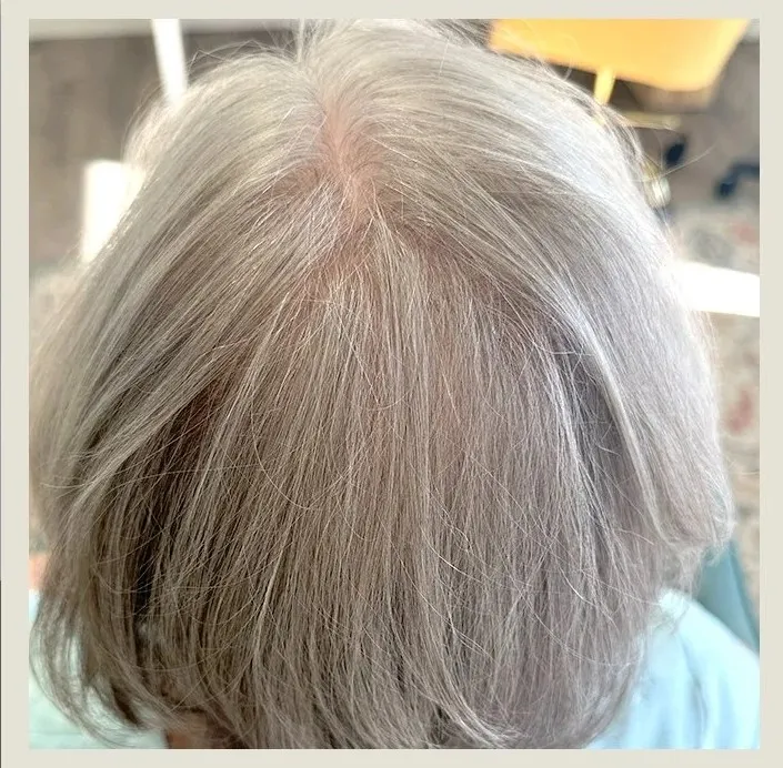 After 4 Months of treatment