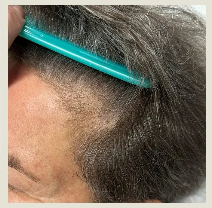 After 2 Months of treatment