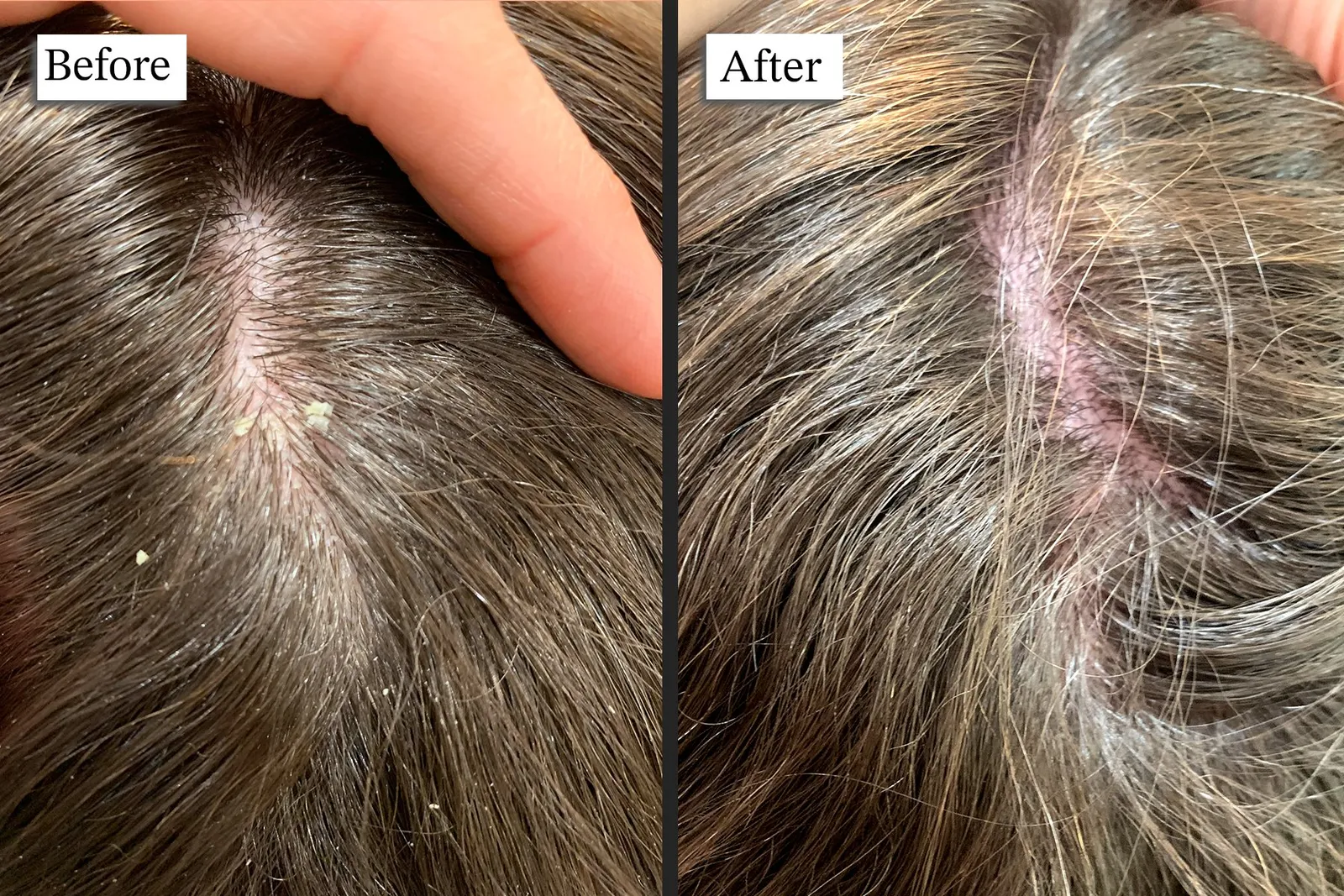 Scalp cleanse before and after