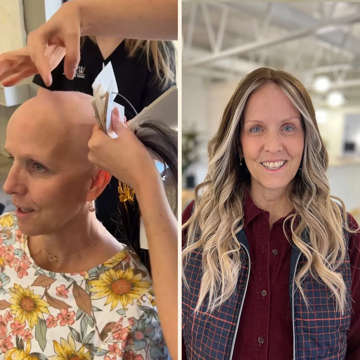 Cranial prosthesis before and after