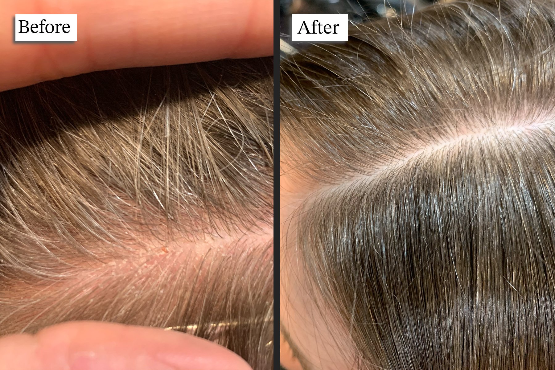 Scalp Cleanse and Renewal