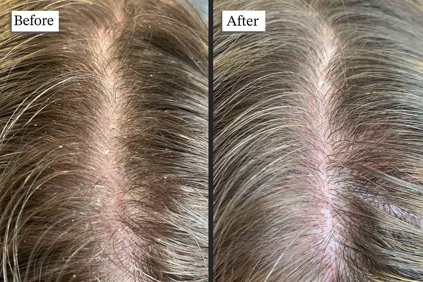 Scalp cleanse treatment