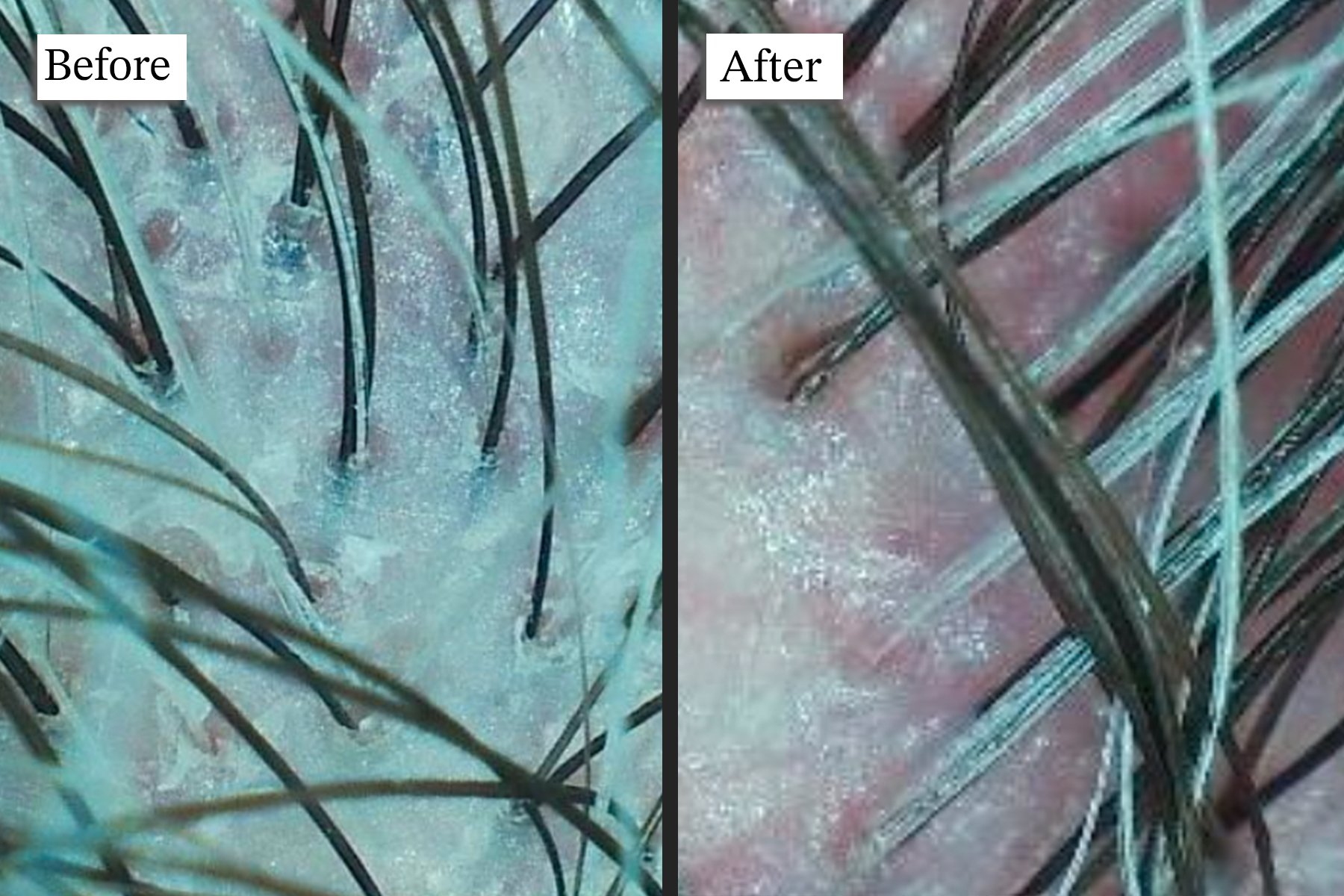 Healthy scalp after treatment