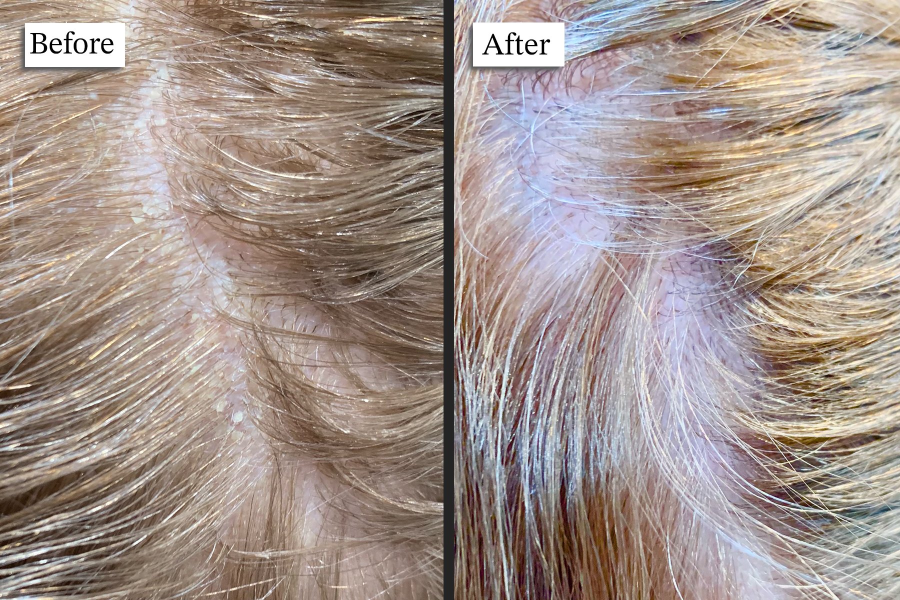 Scalp treatment process